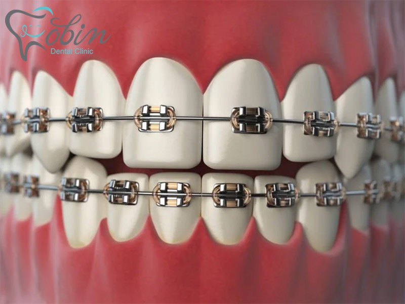 تصویری از ارتودنسی دندان ثابت